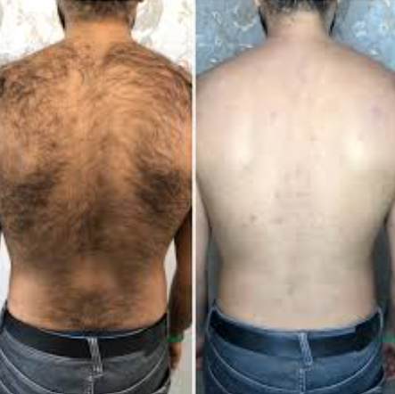 BackBlade Flex – Für eine haarfreie, selbstbewusste Haut!