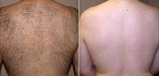 BackBlade Flex – Für eine haarfreie, selbstbewusste Haut!