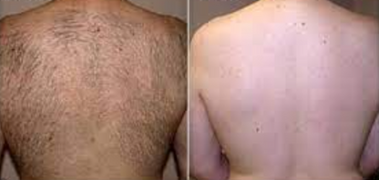BackBlade Flex – Für eine haarfreie, selbstbewusste Haut!