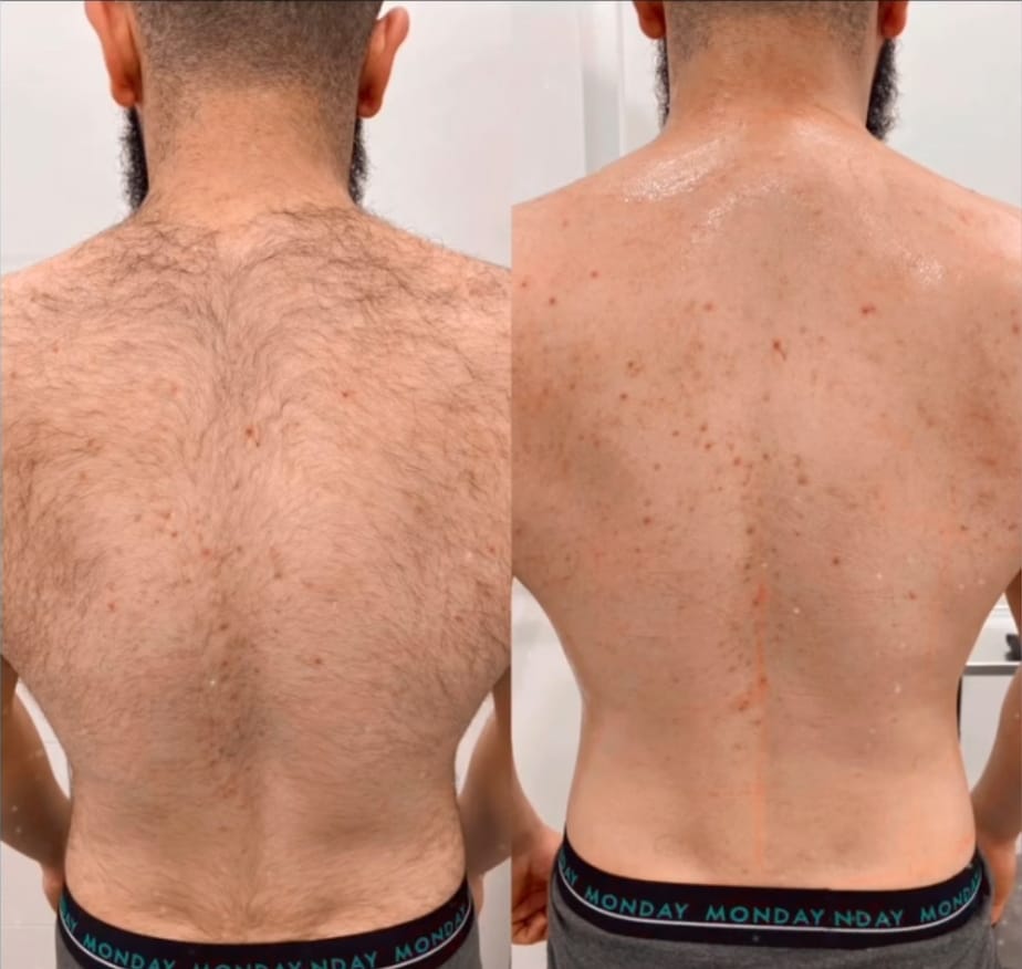 BackBlade Flex – Für eine haarfreie, selbstbewusste Haut!